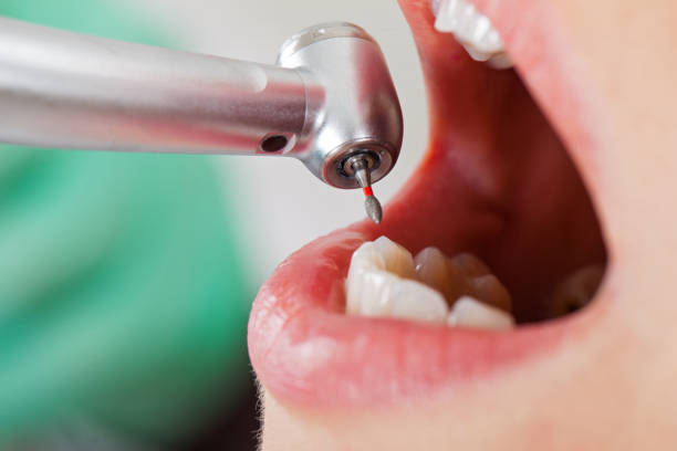 Best Emergency Root Canal Treatment in Taos, MO